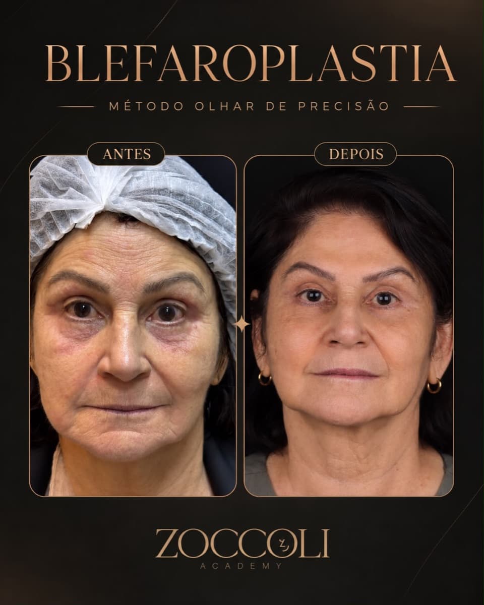 Antes e depois de blefaroplastia