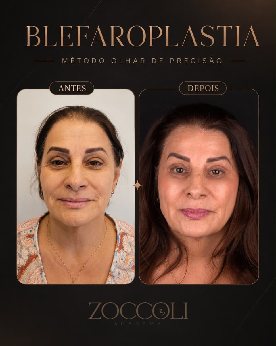 Antes e depois de blefaroplastia