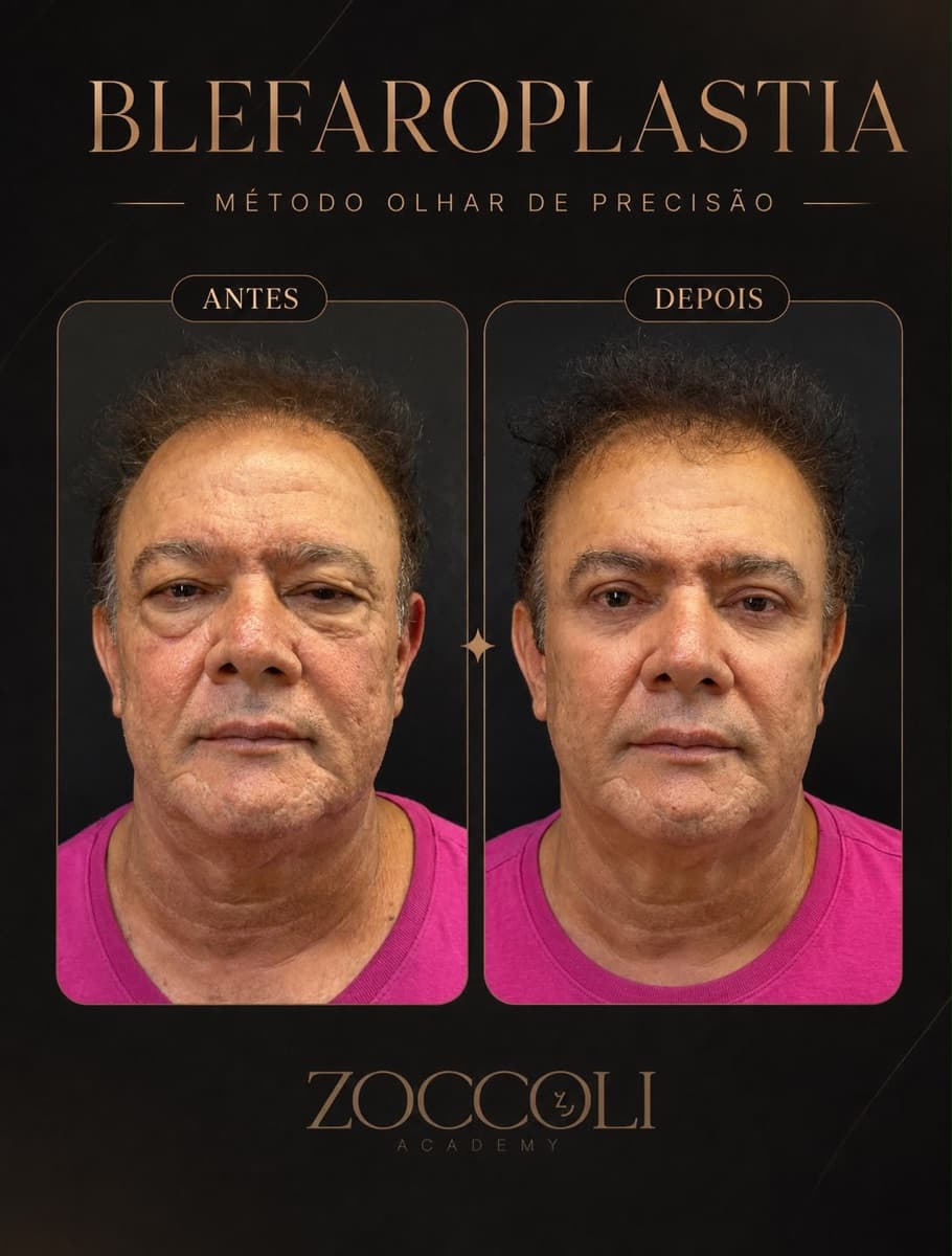 Antes e depois de blefaroplastia