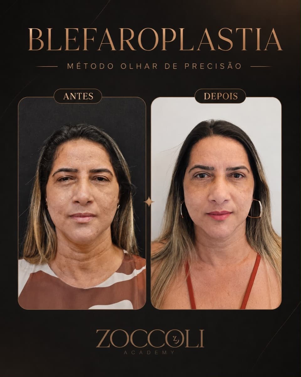 Antes e depois de blefaroplastia